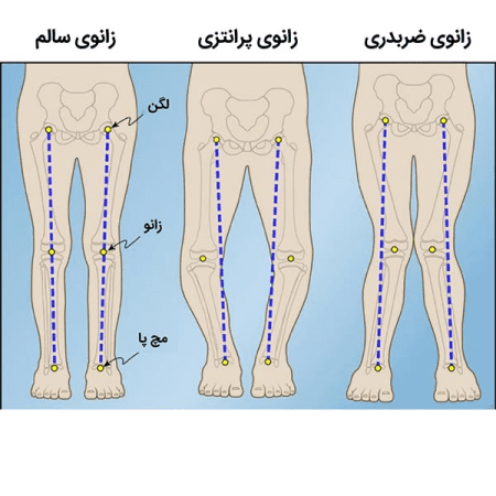 پای پرانتزی